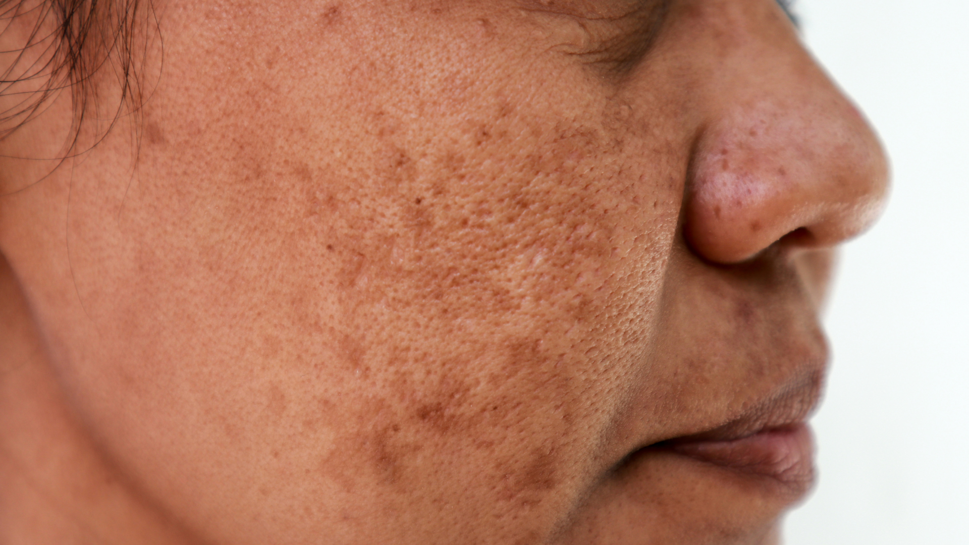 Treating melasma correctly - finally a remedy for dark pigmentation spots